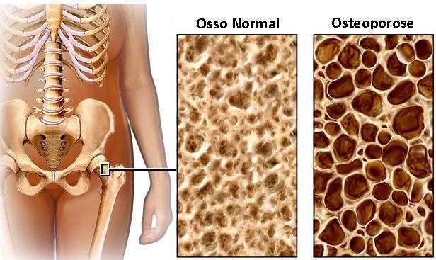 Osteoporose atinge 10 milhões de brasileiros e diagnóstico precoce é essencial para combater a doença, afirma ortopedista