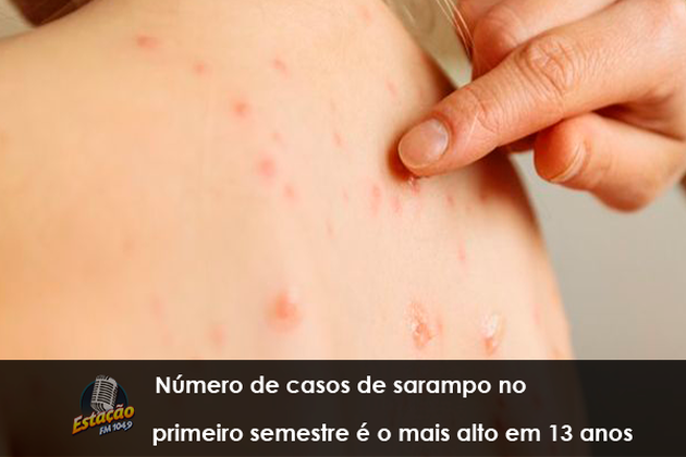 EPIDEMIA: Casos de sarampo no mundo triplicaram em 2019, adverte OMS